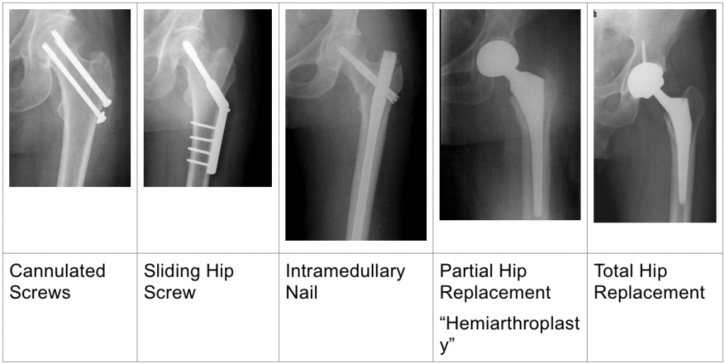 Hip Fracture Dr Jonathan R Danoff Md Orthopedic Surgeon